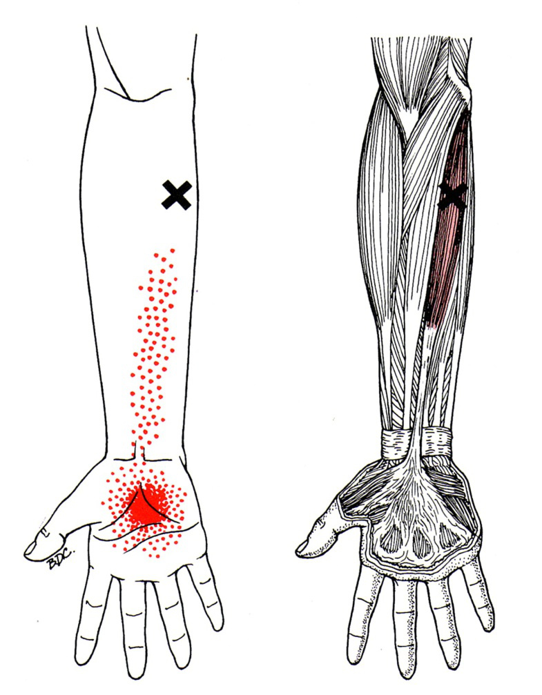 Palmaris Longus The Trigger Point & Referred Pain Guide